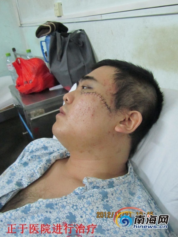　　海大學生追小偷遭刀砍擔心自己會毀容(微博截圖)