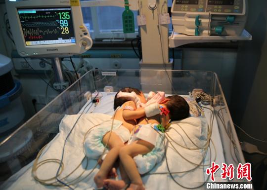 鄭州連體姐妹分體后平安度過圍術期生命體征平穩(wěn)