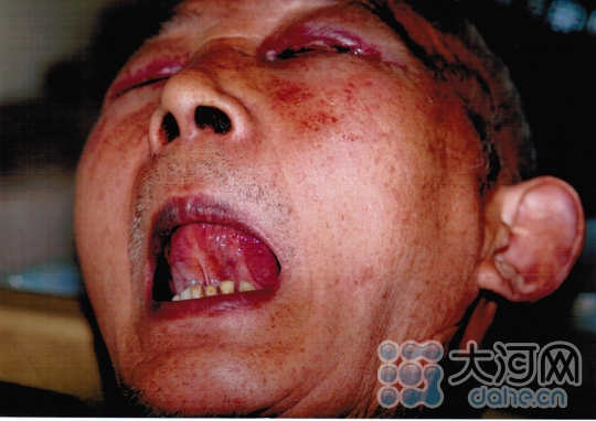任和老人被打后的情形（家屬供圖）