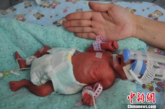 陜西早產(chǎn)“袖珍嬰兒”重約一瓶水面臨多重生存難關(guān)