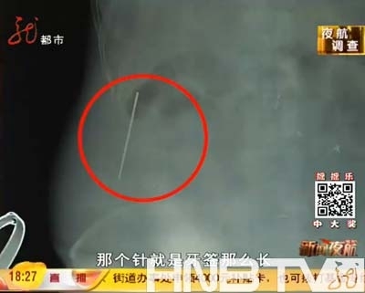 雙城女“神醫”非法治病鋼針留患者肚里取不出來
