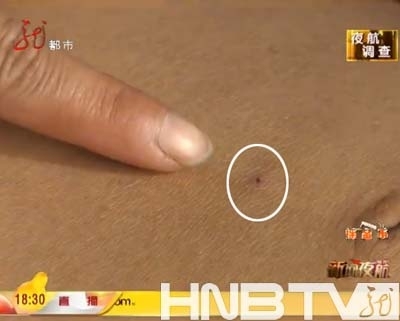 雙城女“神醫”非法治病鋼針留患者肚里取不出來