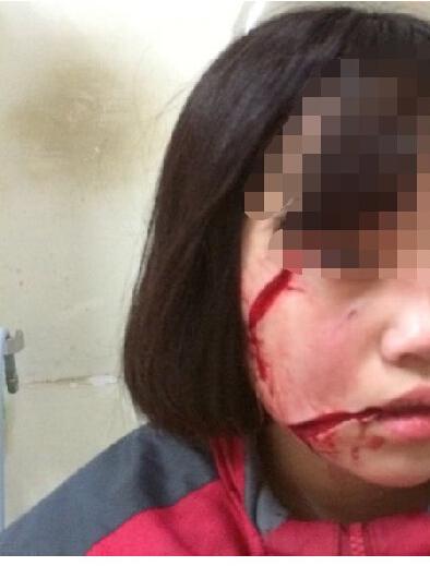 16歲女孩放學路上遭人毀容 右臉被劃兩刀(圖)