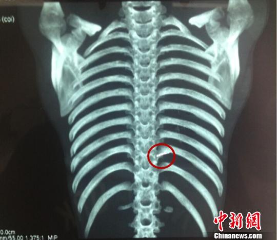 12歲男孩胸部取出5厘米縫衣針藏體內(nèi)4年家長(zhǎng)未察覺(jué)（圖）