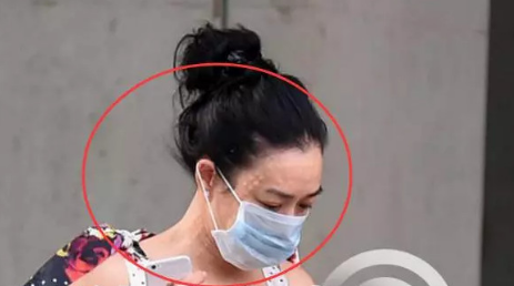 鐘麗緹舊照曝光 額頭脖子布滿“密麻圓點”